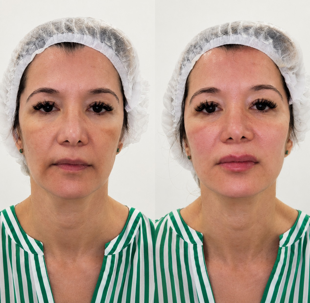 Antes e depois de preenchimento facial realizado no consultório