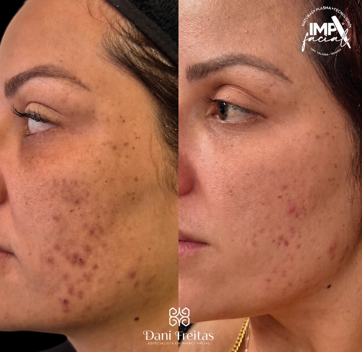 Antes e depois de tratamento IMProving / IMP Facial
