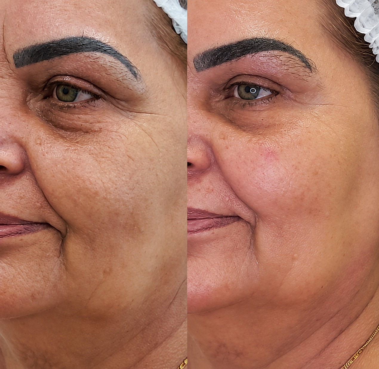 Antes e depois de tratamento com bioestimulador de colágeno