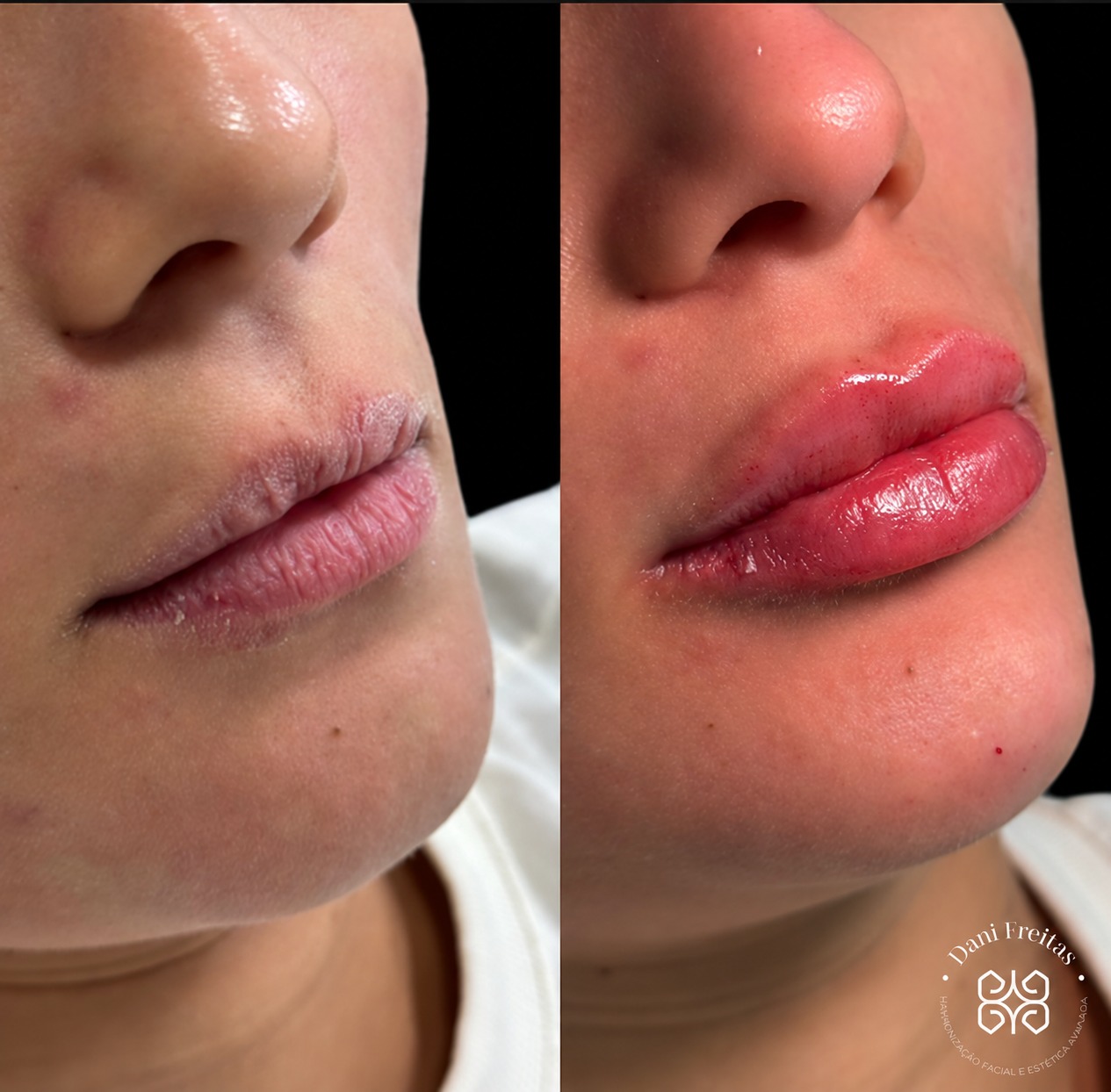 Antes e depois de preenchimento labial realizado no consultório